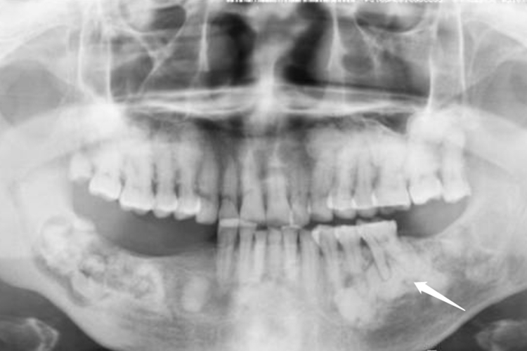 根尖周致密性骨炎X线图 根尖周致密性骨炎X线图
