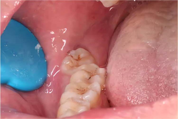 牙齿异位萌出图 牙齿异位萌出图