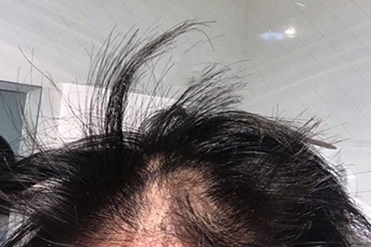 拔毛癖前额头发稀疏图