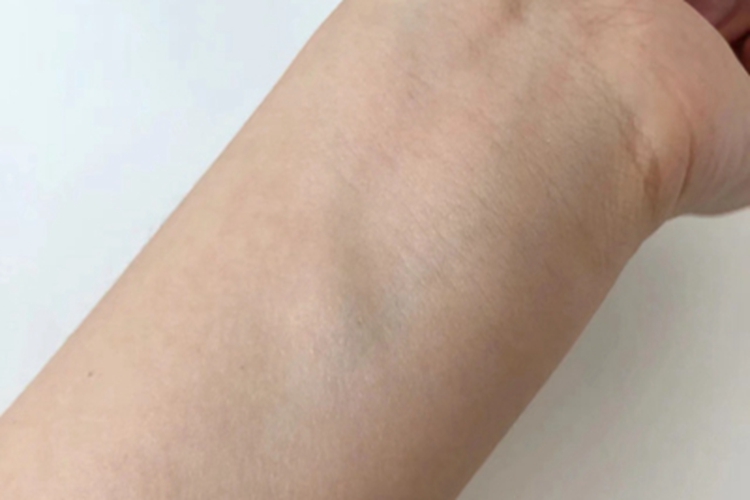 Ⅱ型痛性肥胖病胳膊微微鼓包图