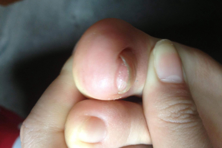 甲下疣图 甲下疣图