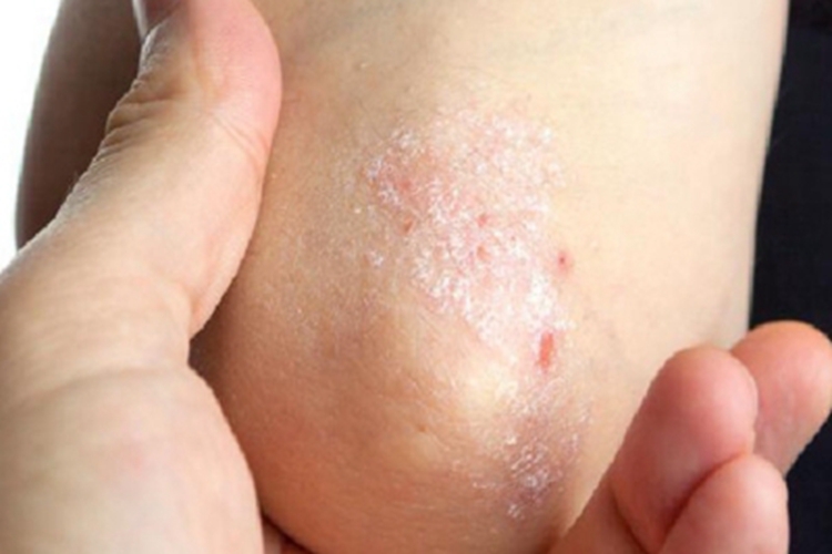 寻常型儿童银屑病肘部症状图 寻常型儿童银屑病肘部症状图