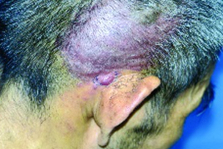 特发性头颈部血管肉瘤头皮紫斑图