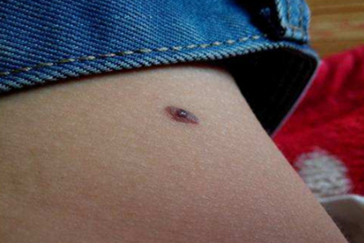 结节性黑素瘤腹部症状图 结节性黑素瘤腹部症状图