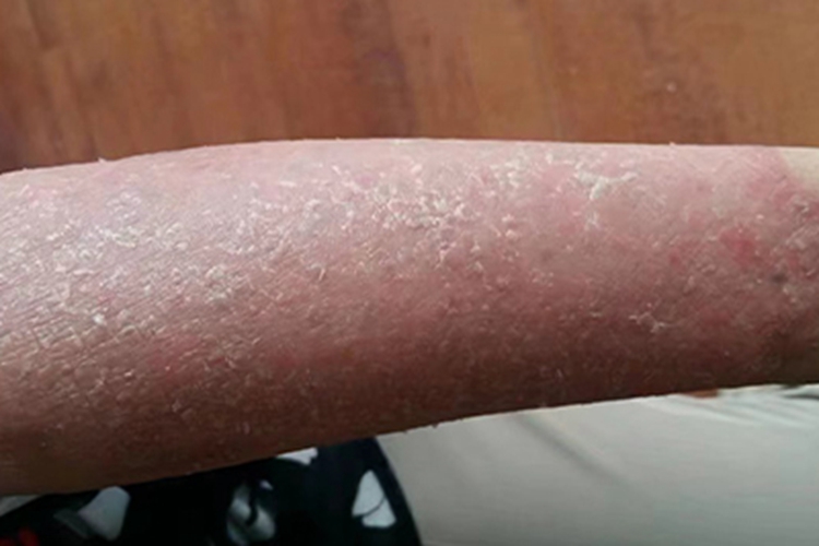 银屑病胳膊脱皮图