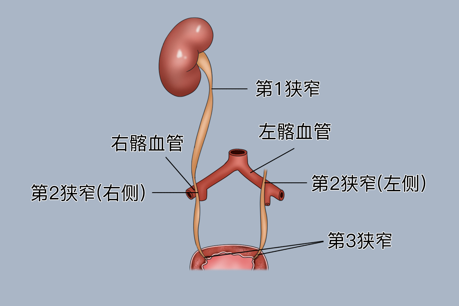 男性输尿管的三个狭窄图