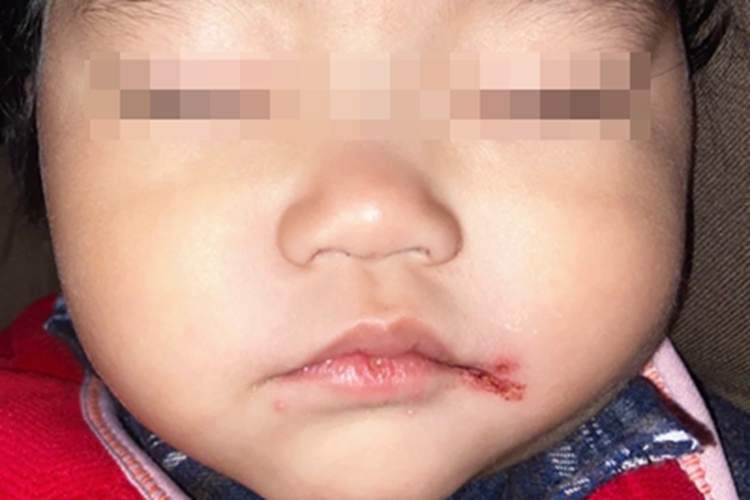 感染性口角炎症状图