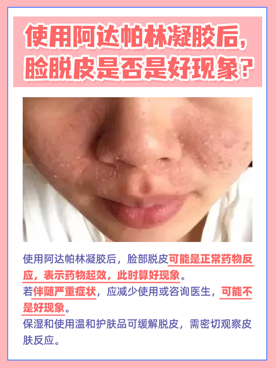 使用阿达帕林凝胶，脸脱皮是好现象吗？