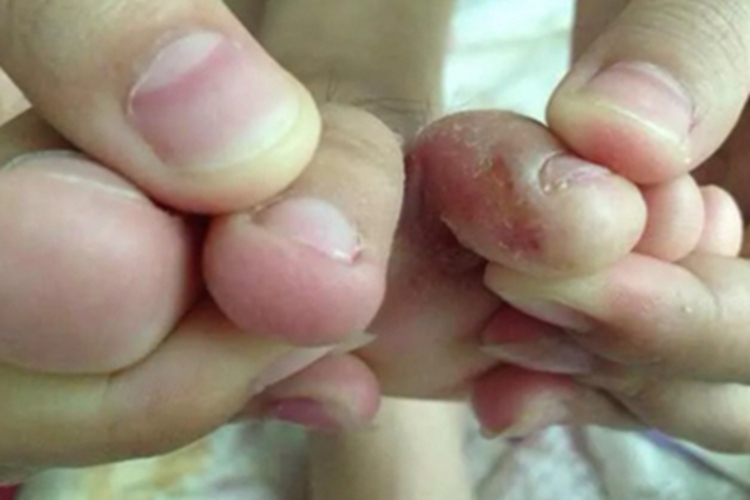 宝宝浸渍糜烂型足癣图 宝宝浸渍糜烂型足癣图