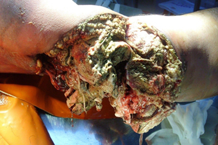 气性坏疽大腿化脓图