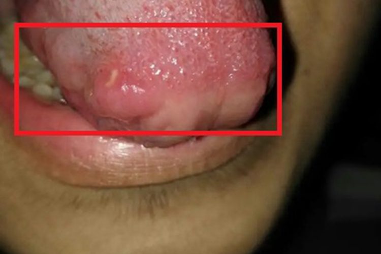 口腔带状疱疹舌头症状图