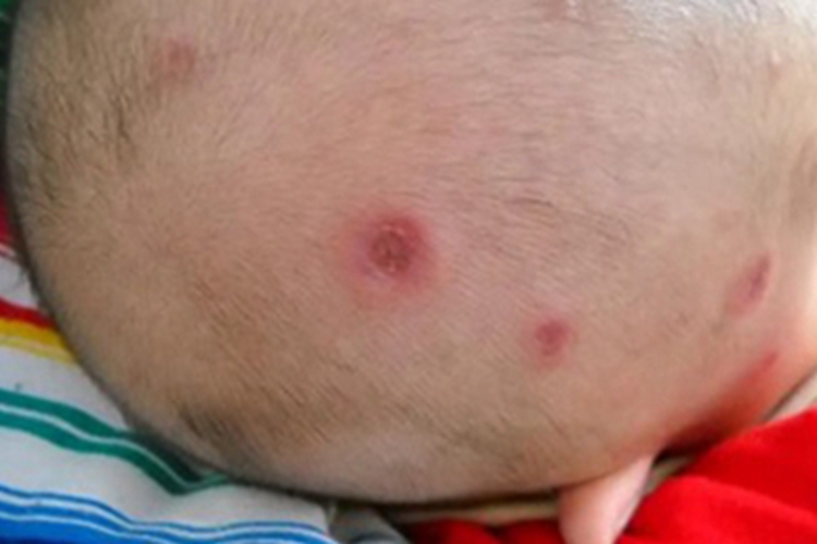 新生儿红斑狼疮头皮症状图 新生儿红斑狼疮头皮症状图