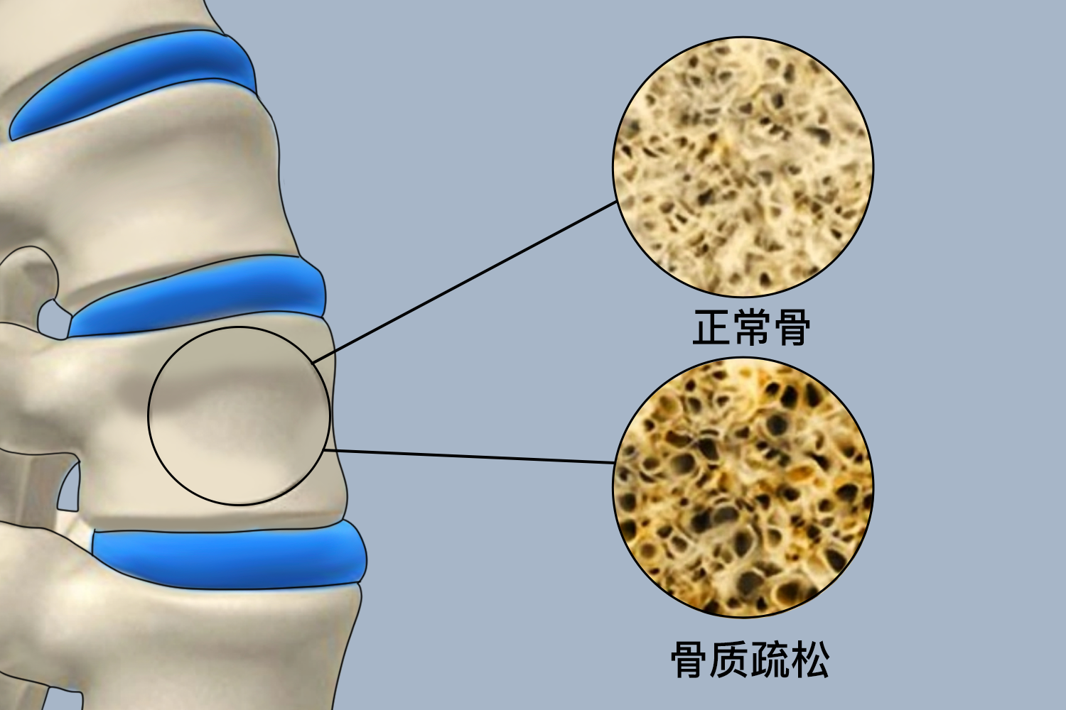 骨质疏松图 骨质疏松图