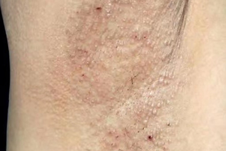 福克斯-福代斯病腋窝丘疹图