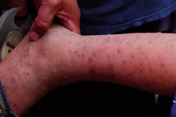 秘鲁疣小腿上长红色丘疹图 秘鲁疣小腿上长红色丘疹图