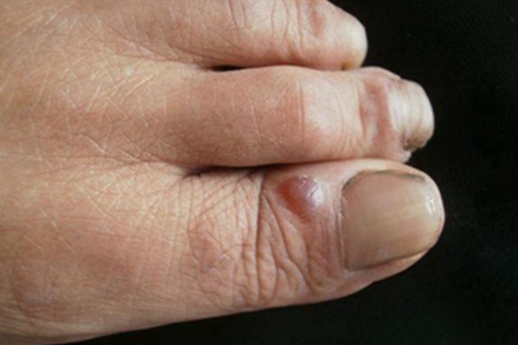 黏液样囊肿脚趾疙瘩图