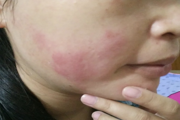 土豆过敏红斑图