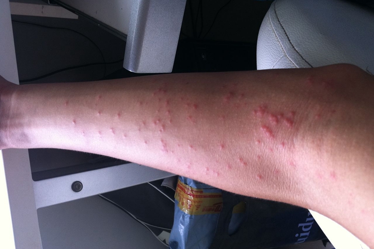 荨麻疹身上红点图