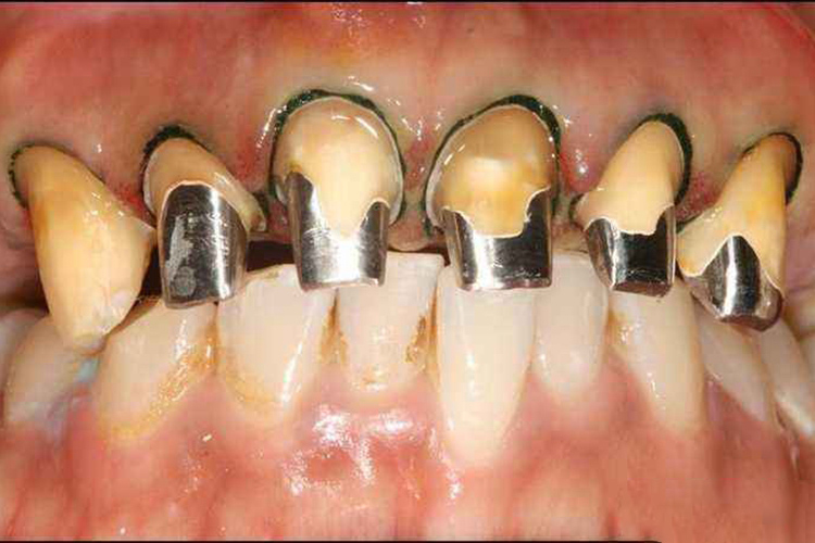 铸造金属舌面板桩冠修复图 铸造金属舌面板桩冠修复图