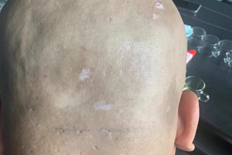 白癜风头皮症状图