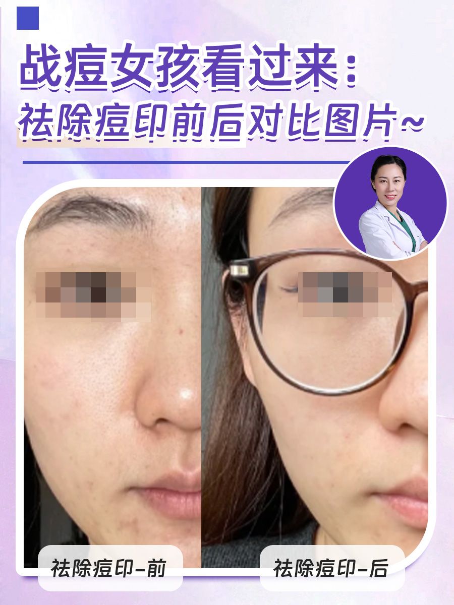 战痘女孩看过来：祛除痘印前后对比图片~
