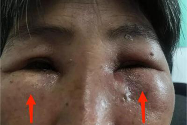 急性泪囊炎眼部肿图