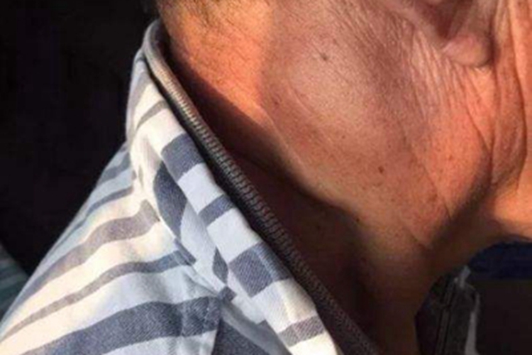 费尔蒂综合征淋巴结肿大症状图 费尔蒂综合征淋巴结肿大症状图