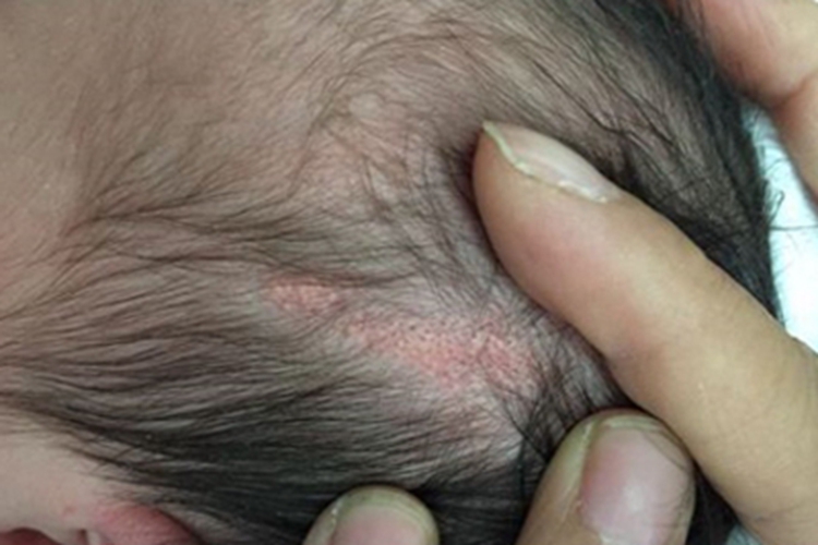 新生儿皮脂腺增生头皮症状图 新生儿皮脂腺增生头皮症状图