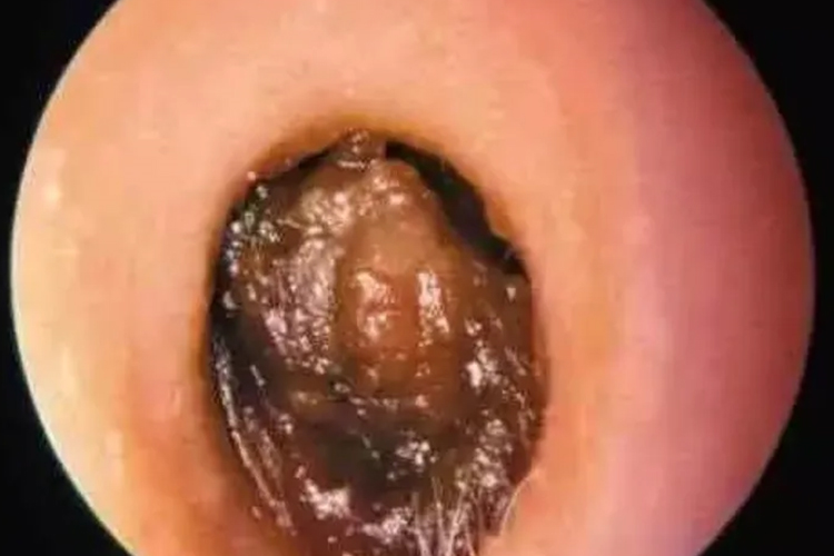 耵聍栓塞图 耵聍栓塞图