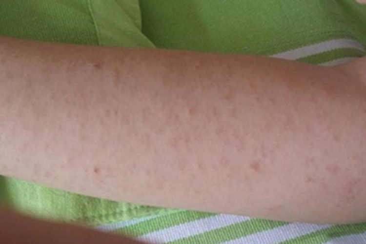 慢性苔藓样糠疹胳膊症状图 慢性苔藓样糠疹胳膊症状图