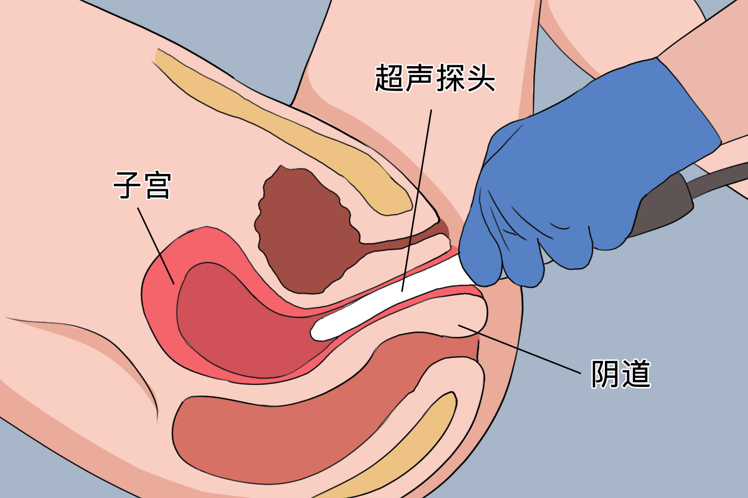 经阴道超声检查图