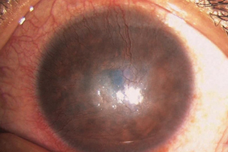 基质性角膜炎水肿图