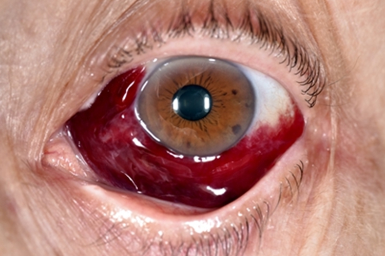 流行性出血性结膜炎症状图 流行性出血性结膜炎症状图