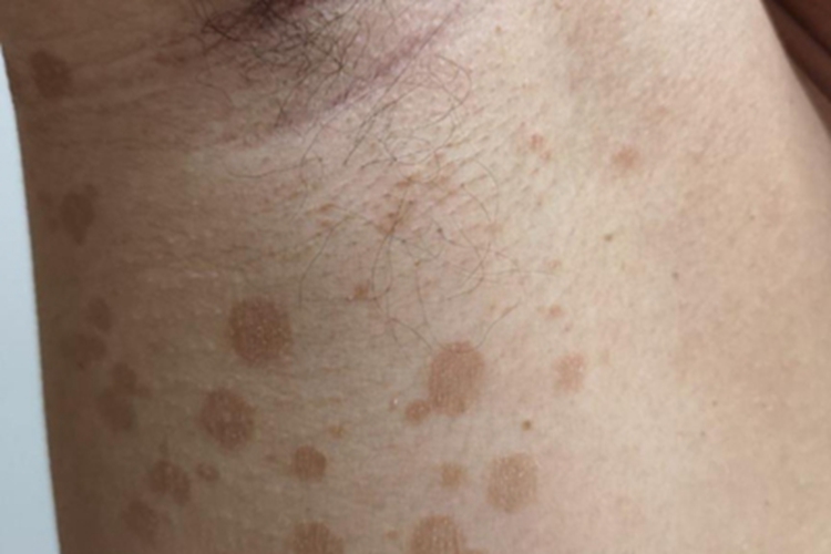 花斑癣腋窝长好多小斑块图