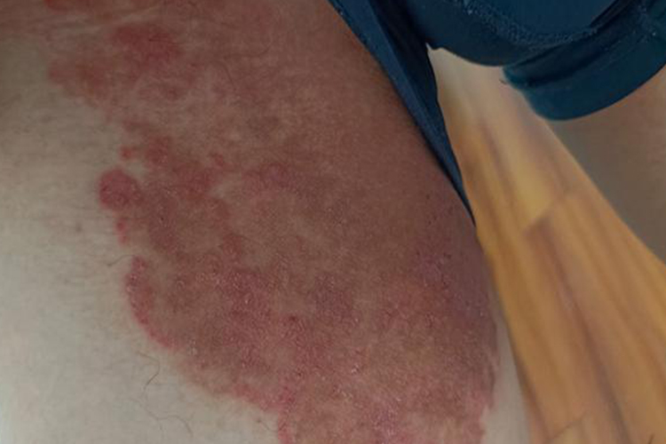 股癣红斑图 股癣红斑图