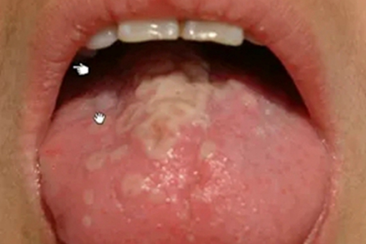 药物过敏性口炎舌头症状图