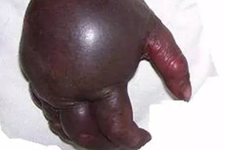 手指感染性坏死图 手指感染性坏死图