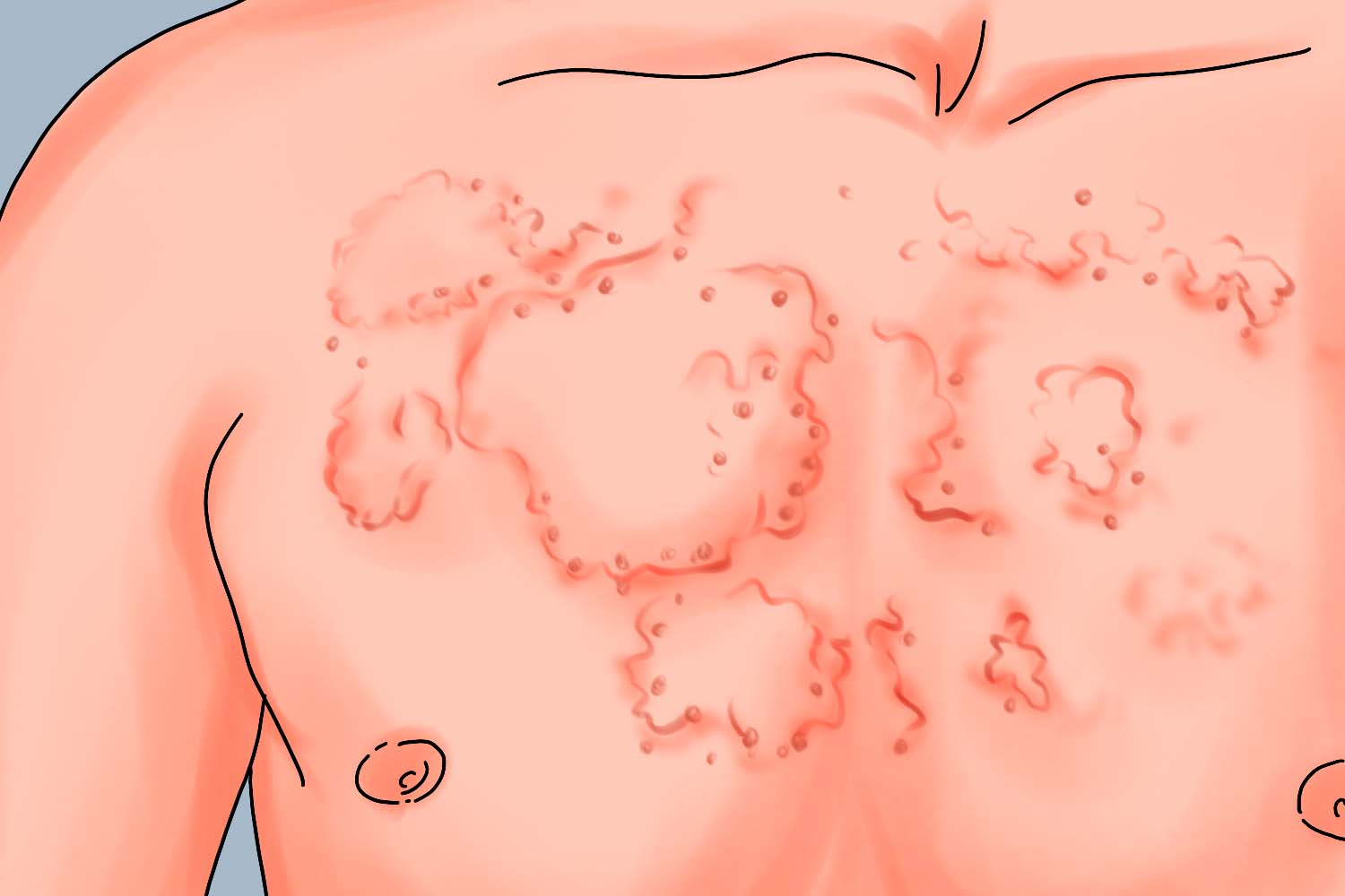 体癣胸部手绘图