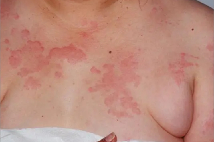 荨麻疹型药疹胸部症状图 荨麻疹型药疹胸部症状图