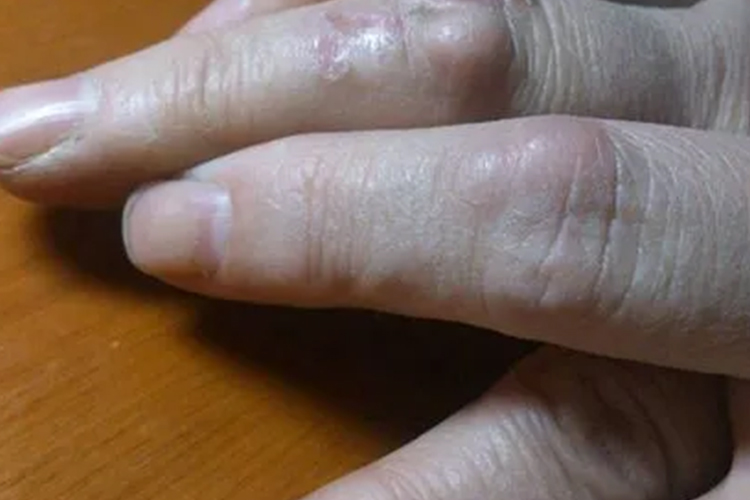 手指表皮样囊肿图