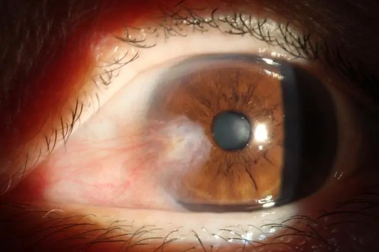 翼状胬肉静止期图