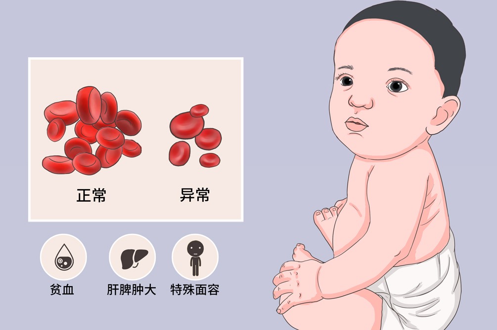 α珠蛋白生成障碍性贫血长相图