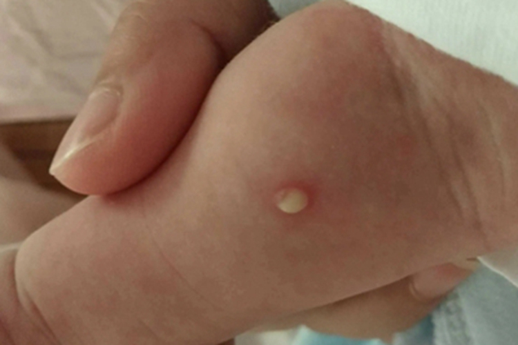 新生儿脓疱疮胳膊脓包图片
