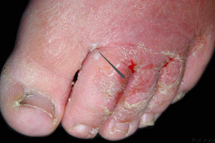 浸渍糜烂型足癣脚趾渗液图