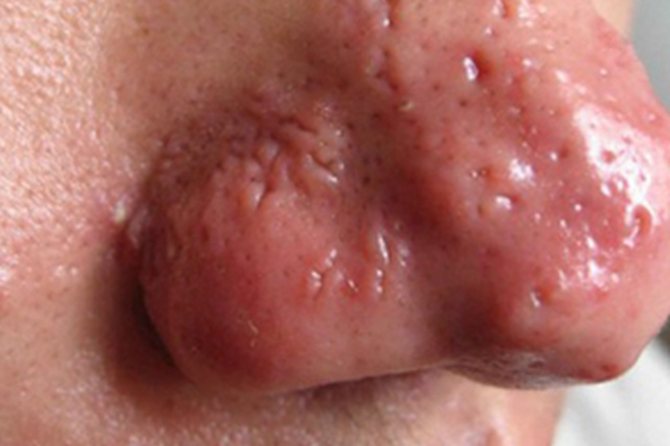 鼻赘型玫瑰痤疮鼻尖症状图
