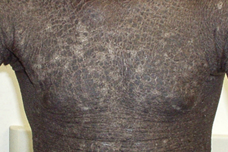 X连锁鱼鳞病皮肤发黑图 X连锁鱼鳞病皮肤发黑图