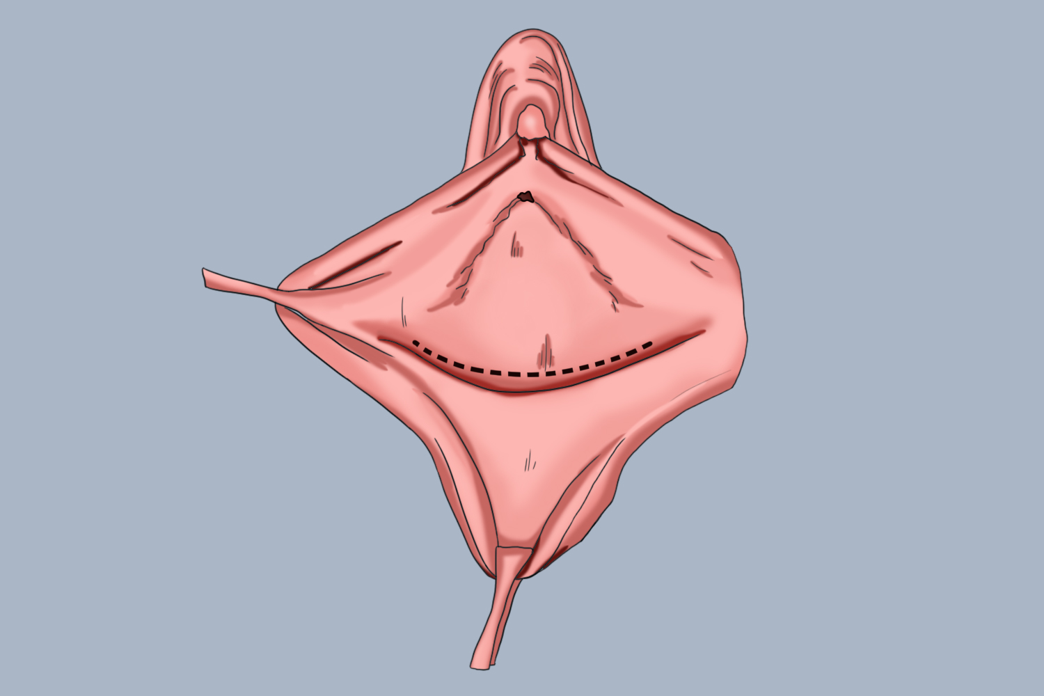 先天性无阴道图