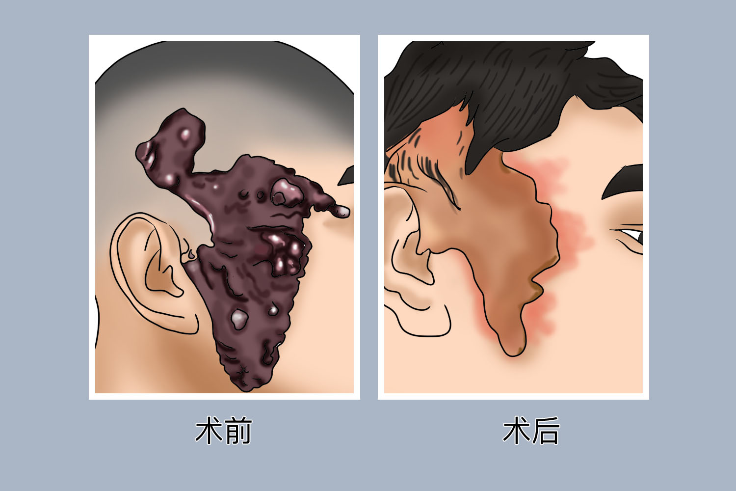 皮脂腺痣手术对比图