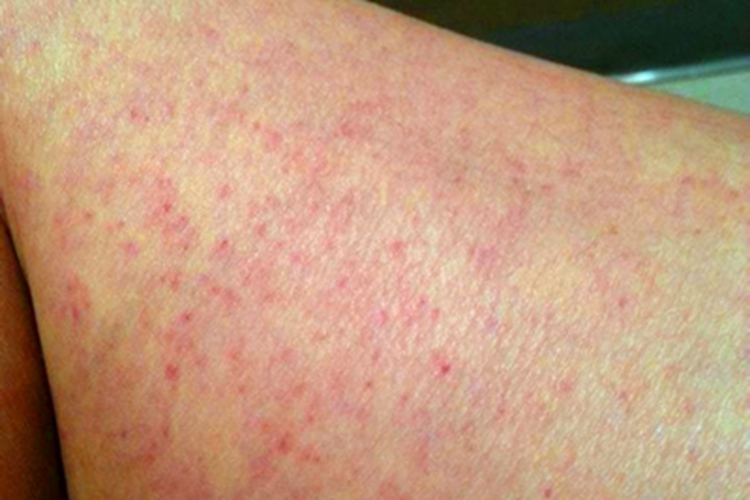 职业性光毒性接触性皮炎血点图<br />
职业性光毒性接触性皮炎血点图<br />