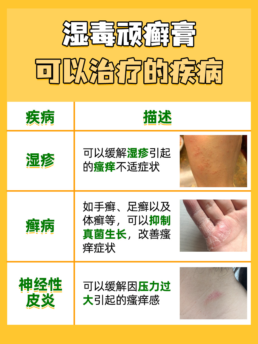 湿毒顽癣膏治什么，一文揭晓！
